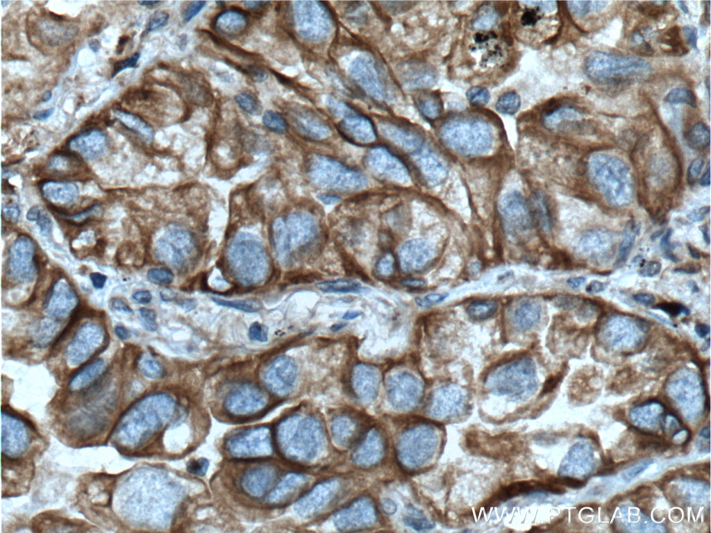 Immunohistochemistry (IHC) staining of human lung cancer tissue using NOTCH3 Polyclonal antibody (55114-1-AP)