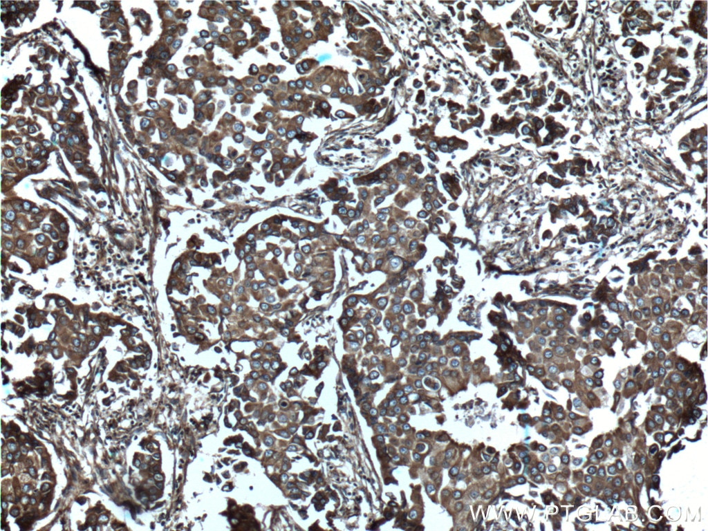 Immunohistochemistry (IHC) staining of human breast cancer tissue using NOTCH3 Polyclonal antibody (55114-1-AP)