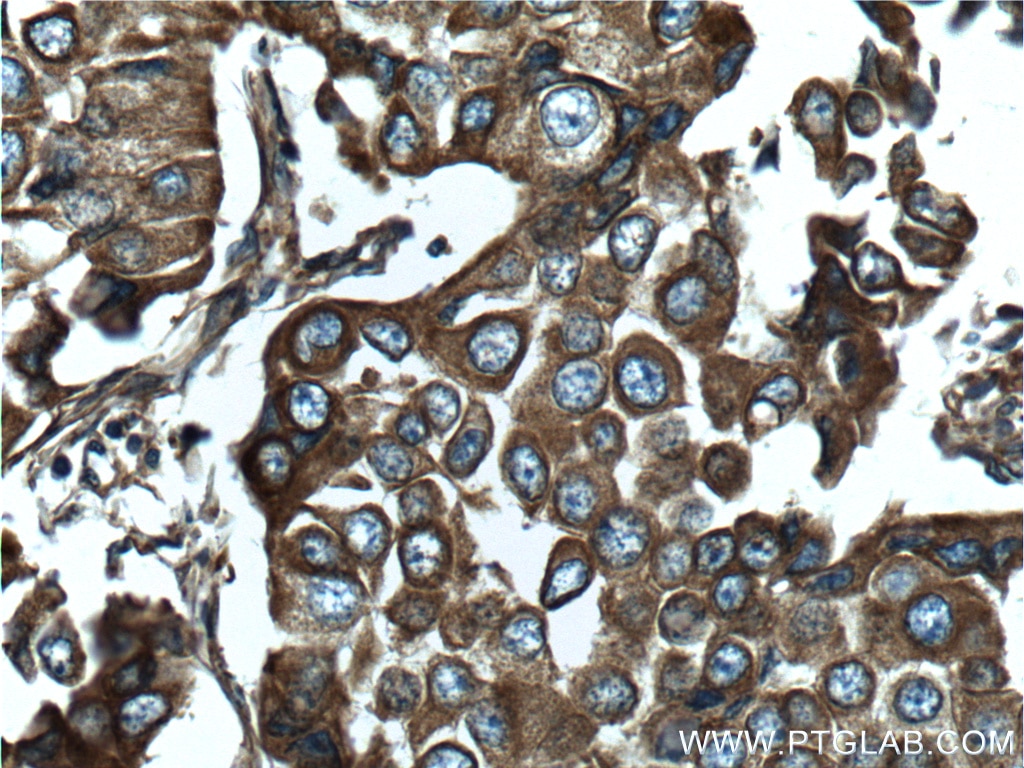 Immunohistochemistry (IHC) staining of human breast cancer tissue using NOTCH3 Polyclonal antibody (55114-1-AP)