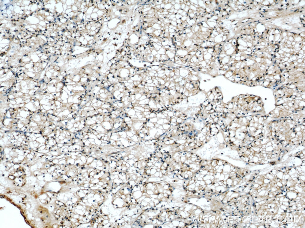 Immunohistochemistry (IHC) staining of human nephroblastoma tissue using CCN3 Polyclonal antibody (55449-1-AP)