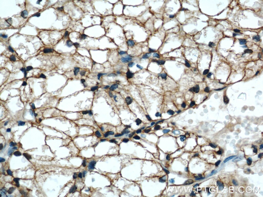 Immunohistochemistry (IHC) staining of human nephroblastoma tissue using CCN3 Polyclonal antibody (55449-1-AP)