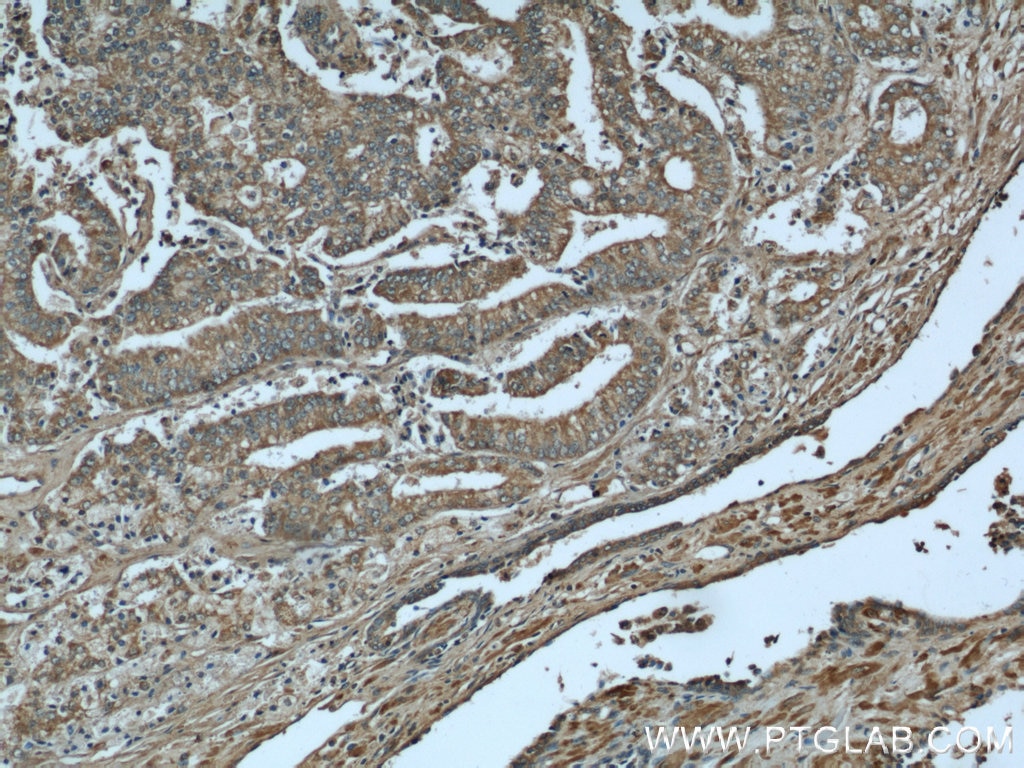 Immunohistochemistry (IHC) staining of human prostate cancer tissue using CCN3 Polyclonal antibody (55449-1-AP)