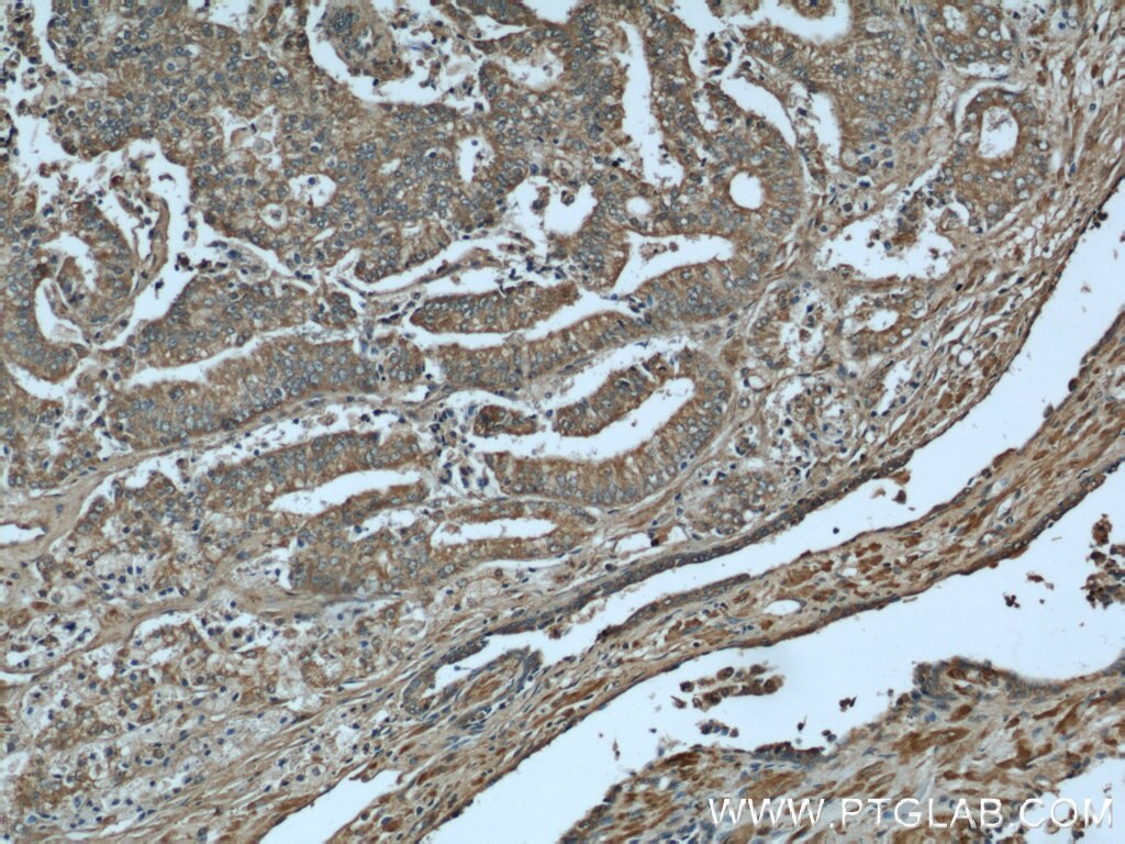 IHC staining of human prostate cancer using 55449-1-AP