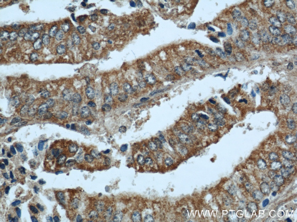 Immunohistochemistry (IHC) staining of human prostate cancer tissue using CCN3 Polyclonal antibody (55449-1-AP)