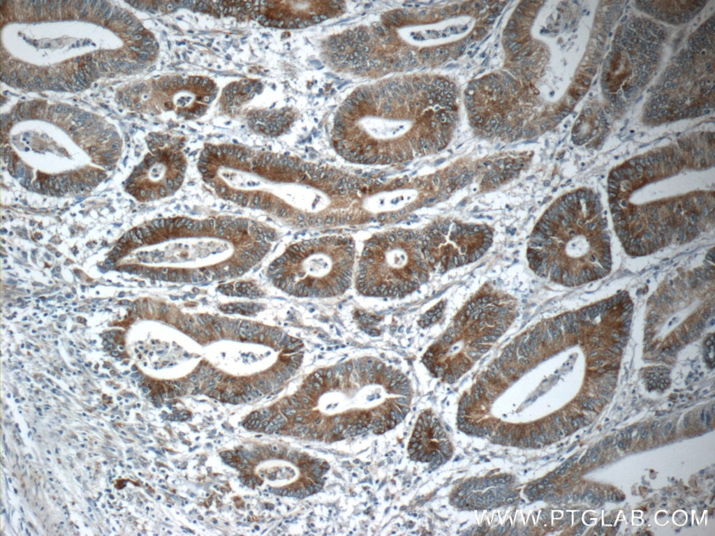 Immunohistochemistry (IHC) staining of human colon cancer tissue using NPB Polyclonal antibody (25517-1-AP)