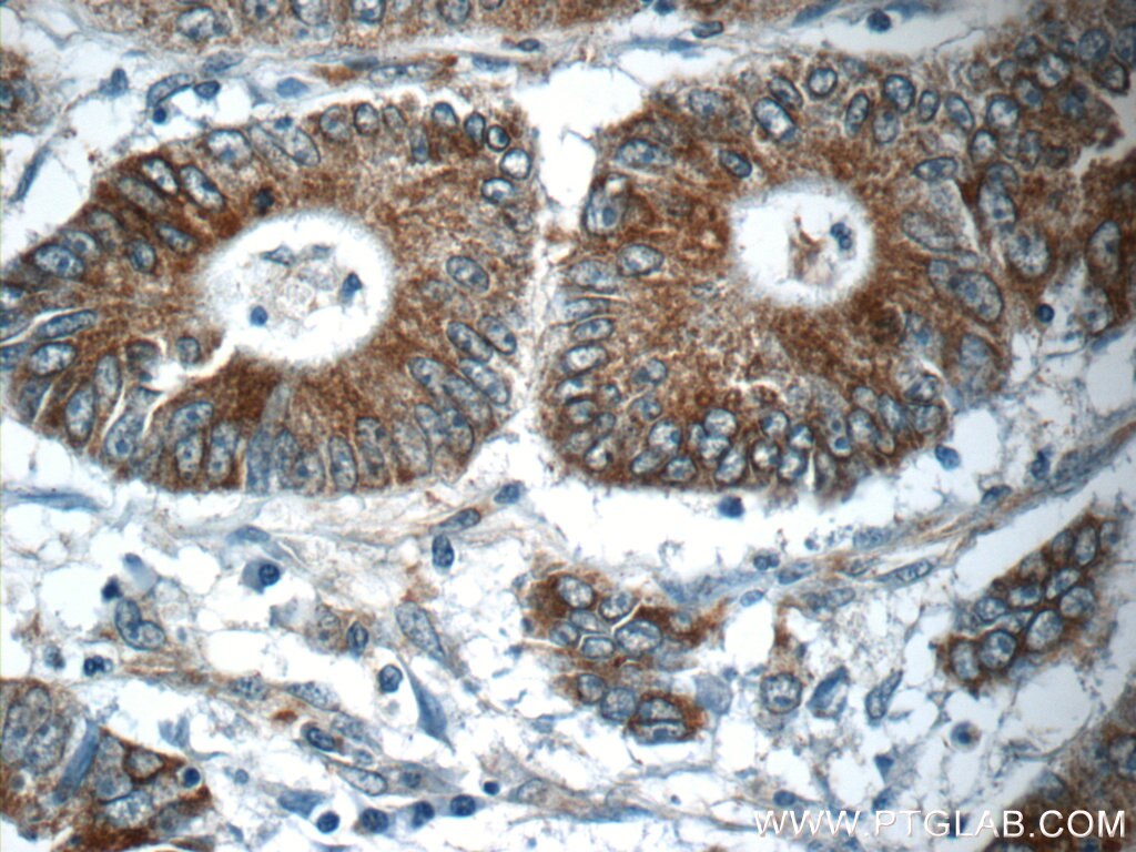 Immunohistochemistry (IHC) staining of human colon cancer tissue using NPB Polyclonal antibody (25517-1-AP)