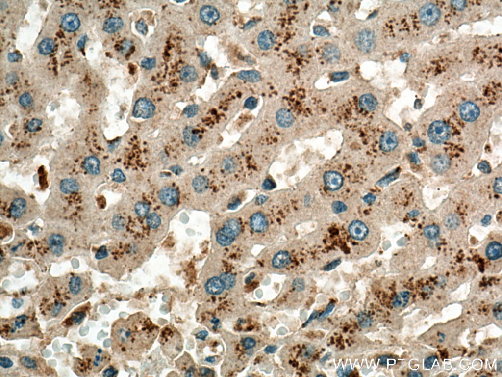 Immunohistochemistry (IHC) staining of human liver cancer tissue using NPC1 Polyclonal antibody (13926-1-AP)