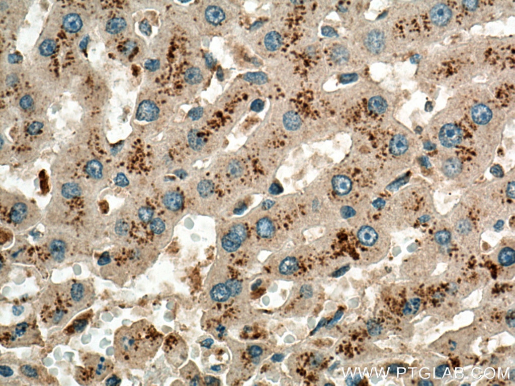 Immunohistochemistry (IHC) staining of human liver cancer tissue using NPC1 Polyclonal antibody (13926-1-AP)