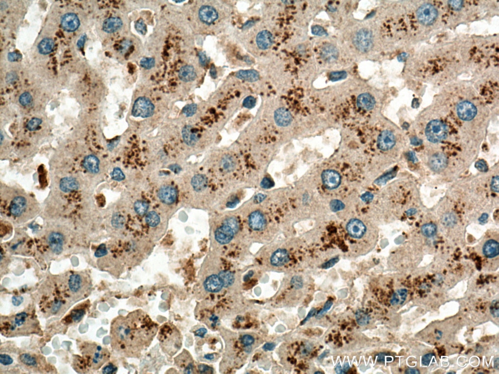 IHC staining of human liver cancer using 13926-1-AP