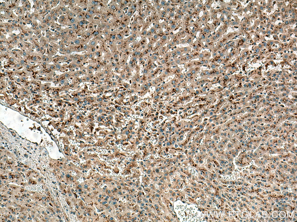 Immunohistochemistry (IHC) staining of human liver cancer tissue using NPC1 Polyclonal antibody (13926-1-AP)