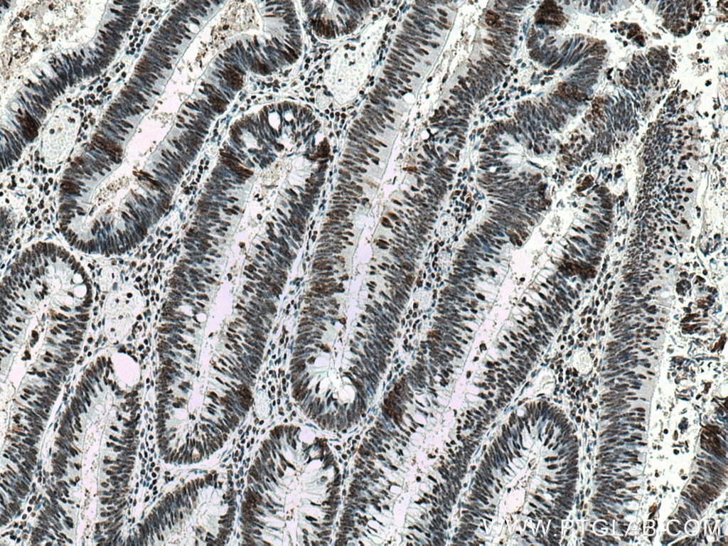 Immunohistochemistry (IHC) staining of human colon cancer tissue using B23/NPM1 Polyclonal antibody (10306-1-AP)