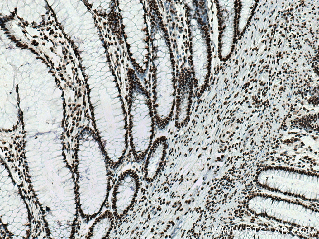 IHC staining of human colon cancer using 10306-1-AP