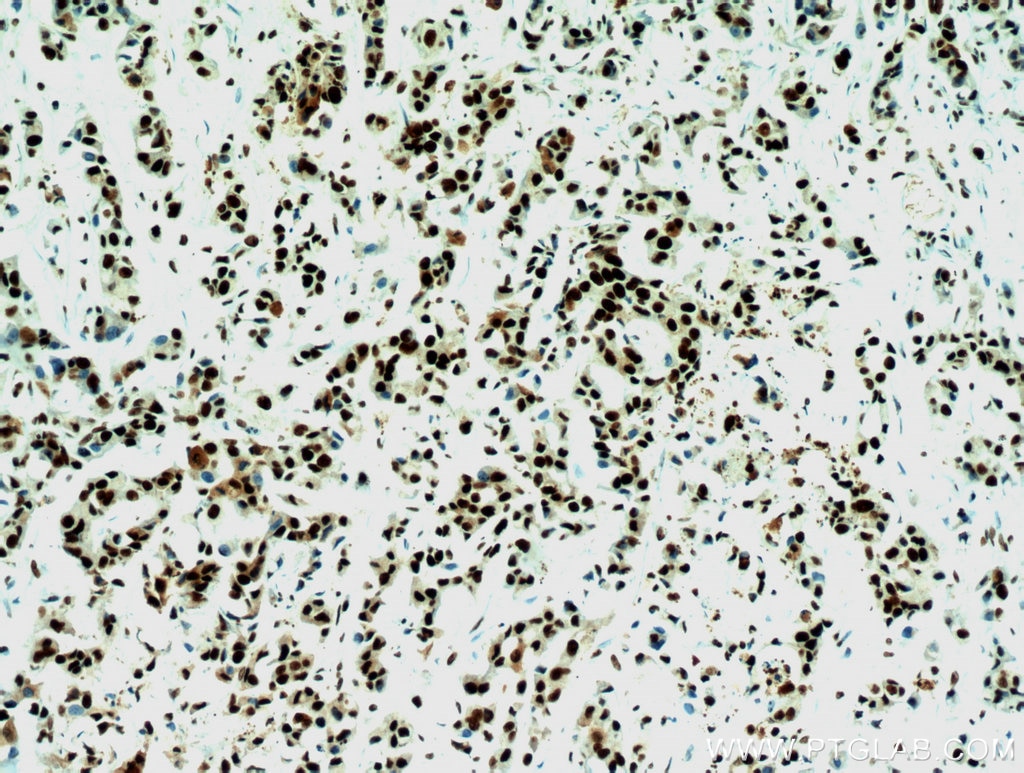 Immunohistochemistry (IHC) staining of human breast cancer tissue using B23/NPM1 Polyclonal antibody (10306-1-AP)