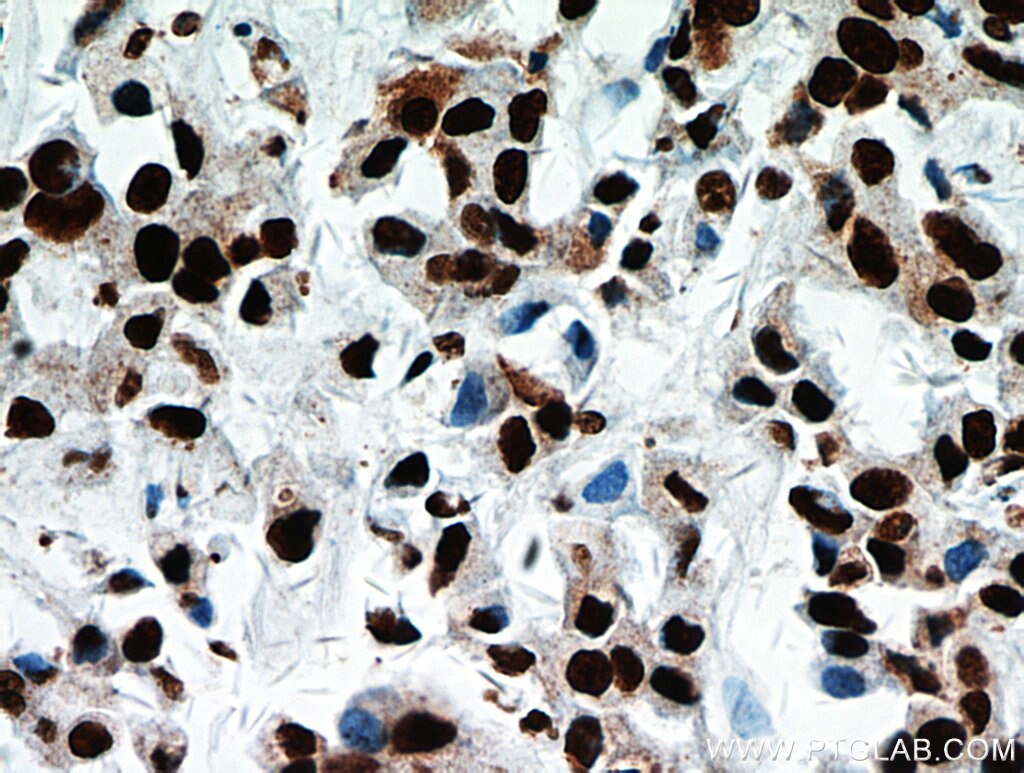 Immunohistochemistry (IHC) staining of human breast cancer tissue using B23/NPM1 Polyclonal antibody (10306-1-AP)