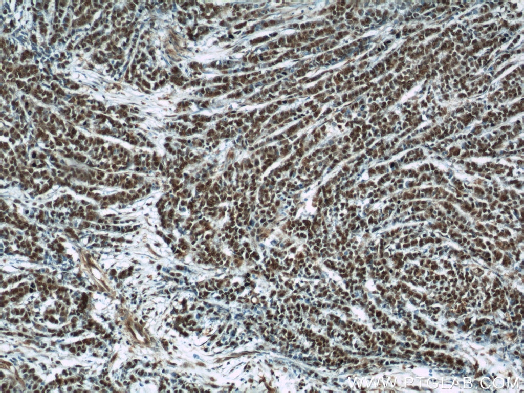 Immunohistochemistry (IHC) staining of human colon cancer tissue using B23/NPM1 Polyclonal antibody (10306-1-AP)