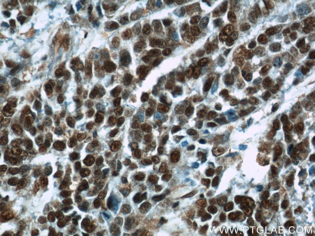 Immunohistochemistry (IHC) staining of human colon cancer tissue using B23/NPM1 Polyclonal antibody (10306-1-AP)