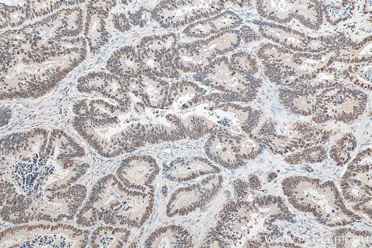 Immunohistochemistry (IHC) staining of human colon cancer tissue using B23/NPM1 Monoclonal antibody (60096-1-Ig)