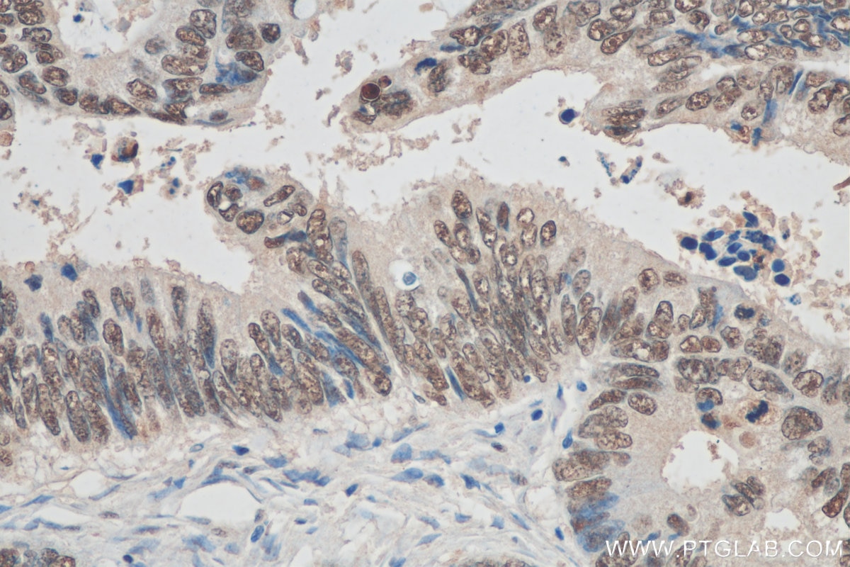 IHC staining of human colon cancer using 60096-1-Ig