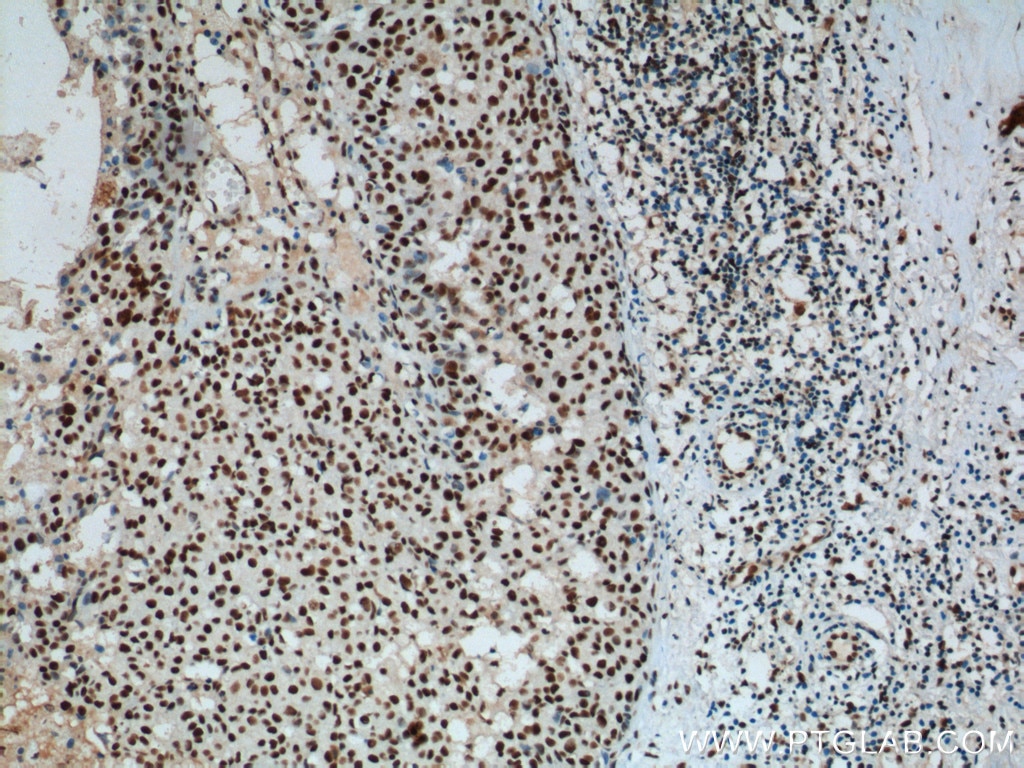 Immunohistochemistry (IHC) staining of human breast cancer tissue using B23/NPM1 Monoclonal antibody (60096-1-Ig)