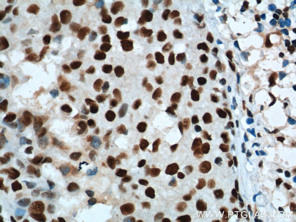 Immunohistochemistry (IHC) staining of human breast cancer tissue using B23/NPM1 Monoclonal antibody (60096-1-Ig)