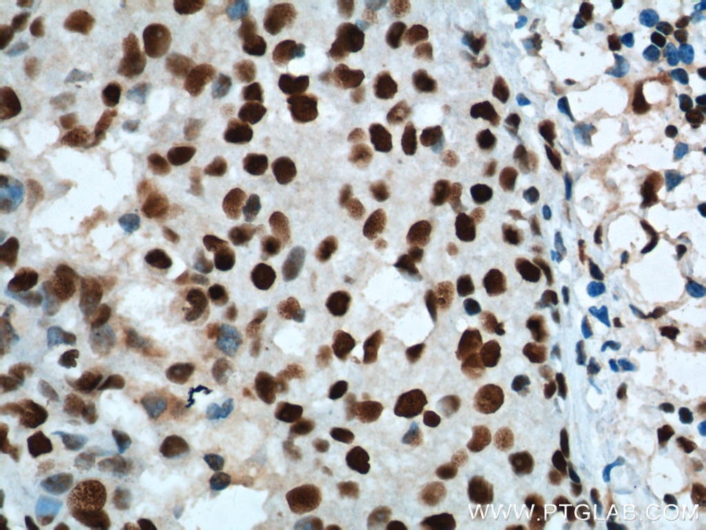 IHC staining of human breast cancer using 60096-1-Ig