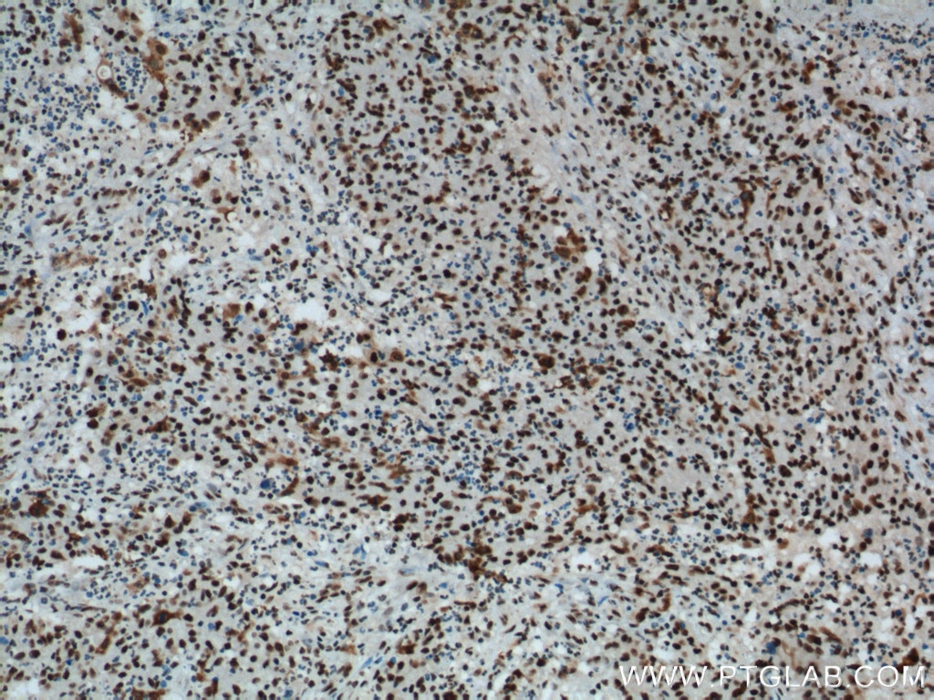 Immunohistochemistry (IHC) staining of human colon cancer tissue using B23/NPM1 Monoclonal antibody (60096-1-Ig)