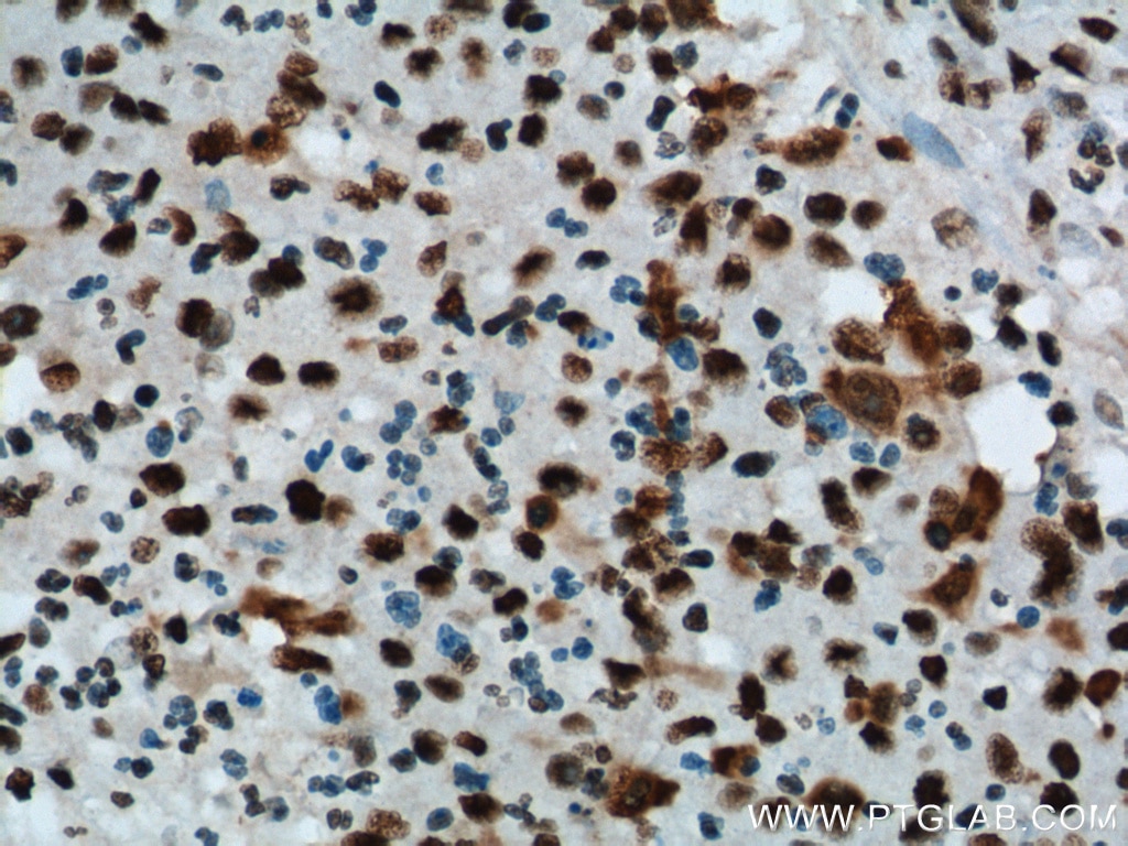 Immunohistochemistry (IHC) staining of human colon cancer tissue using B23/NPM1 Monoclonal antibody (60096-1-Ig)