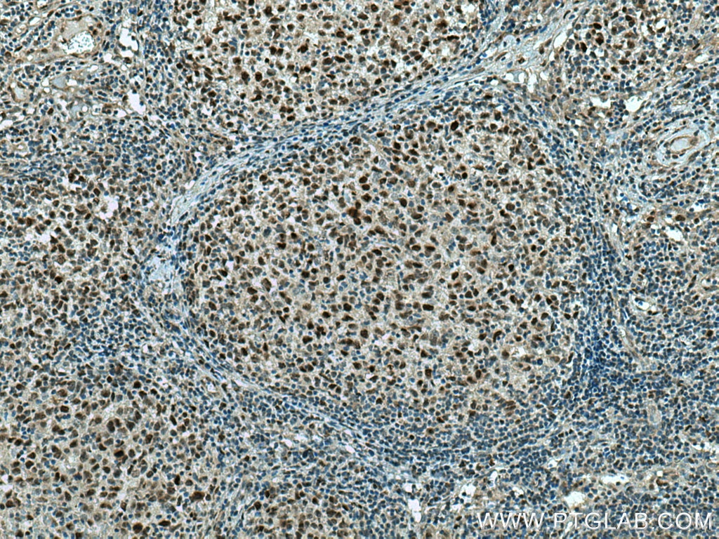 Immunohistochemistry (IHC) staining of human lymphoma tissue using NPM3 Polyclonal antibody (11960-1-AP)