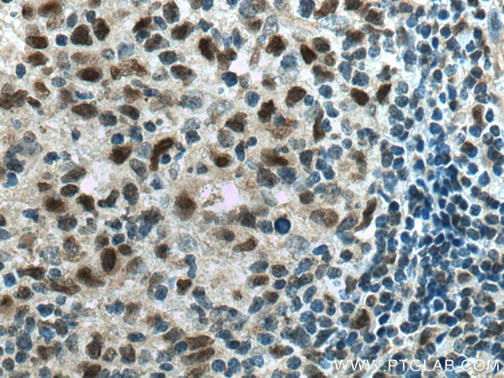 Immunohistochemistry (IHC) staining of human lymphoma tissue using NPM3 Polyclonal antibody (11960-1-AP)