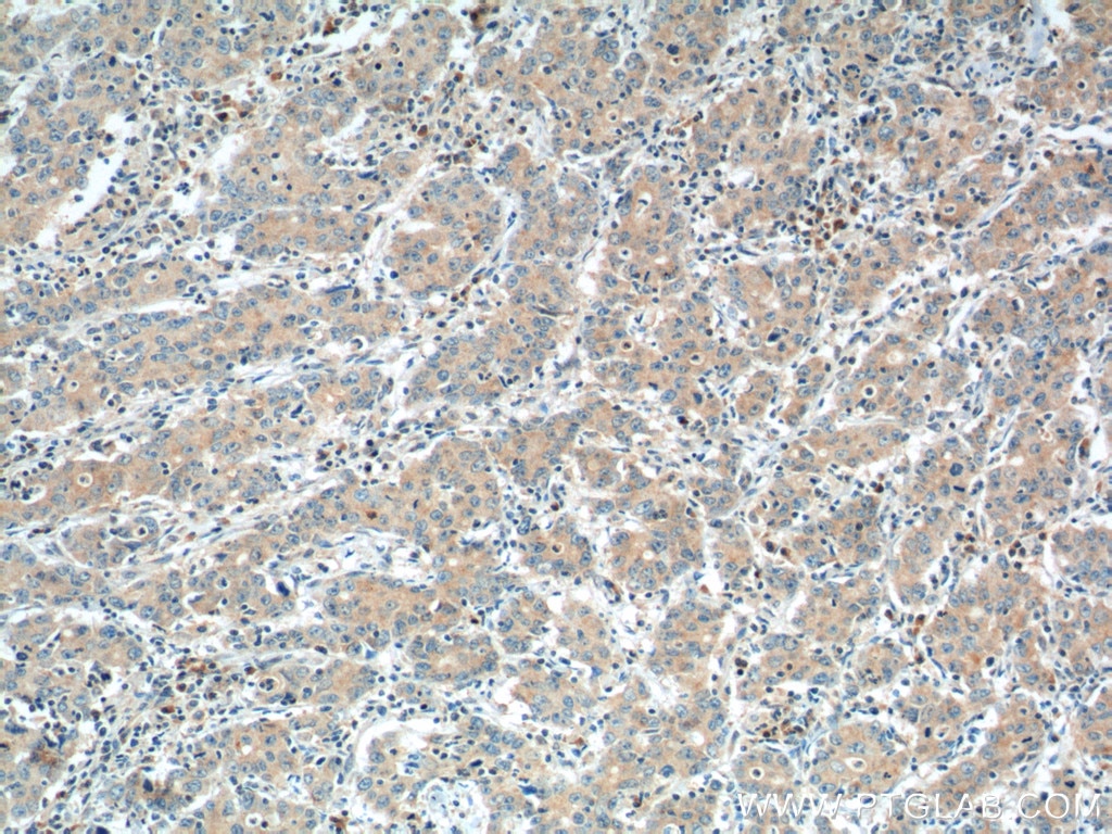 Immunohistochemistry (IHC) staining of human stomach cancer tissue using NPR1 Polyclonal antibody (55116-1-AP)