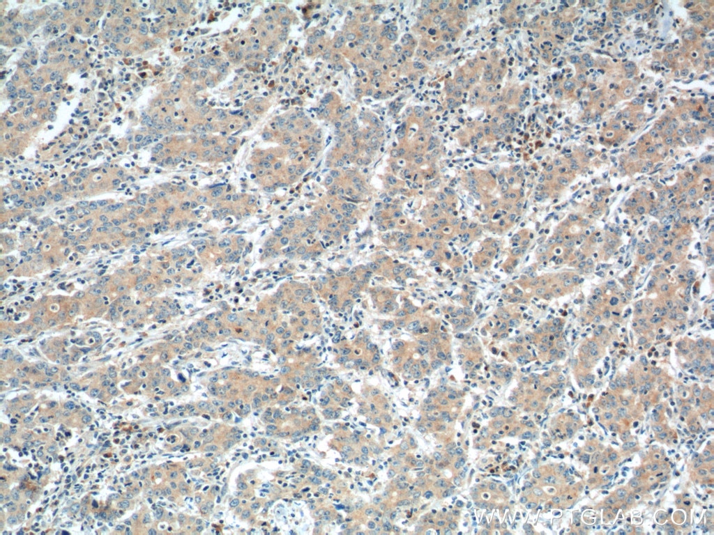 IHC staining of human stomach cancer using 55116-1-AP