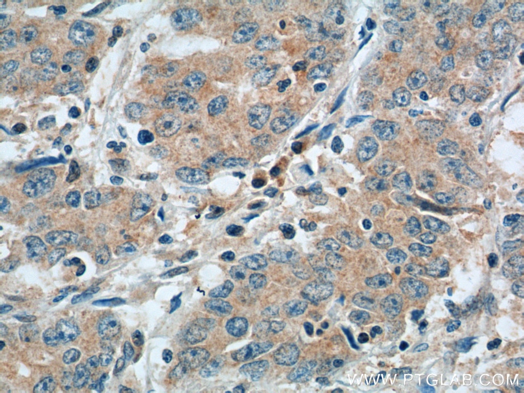 Immunohistochemistry (IHC) staining of human stomach cancer tissue using NPR1 Polyclonal antibody (55116-1-AP)