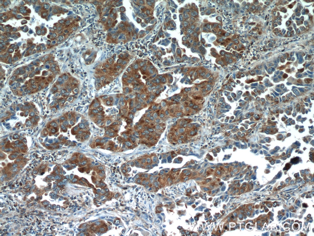 Immunohistochemistry (IHC) staining of human lung cancer tissue using NPRL2 Polyclonal antibody (10157-1-AP)