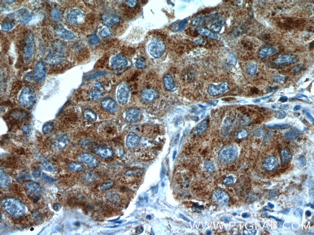 Immunohistochemistry (IHC) staining of human lung cancer tissue using NPRL2 Polyclonal antibody (10157-1-AP)
