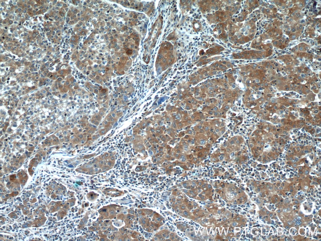 Immunohistochemistry (IHC) staining of human liver cancer tissue using NPR3 Polyclonal antibody (25248-1-AP)