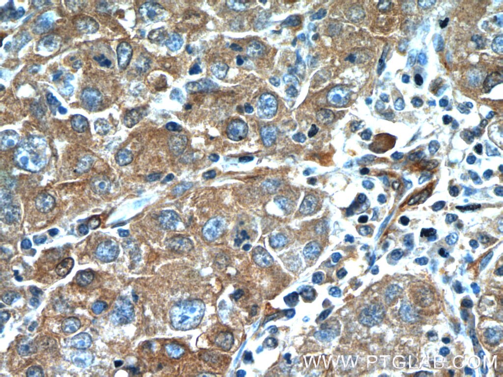 Immunohistochemistry (IHC) staining of human liver cancer tissue using NPR3 Polyclonal antibody (25248-1-AP)