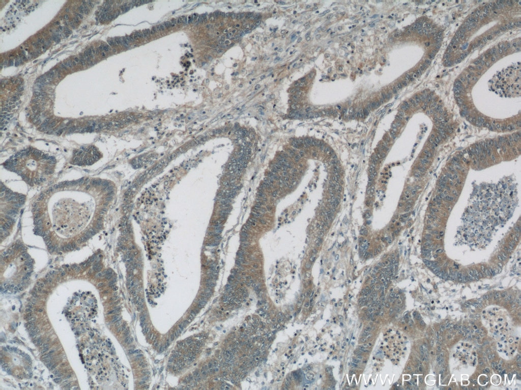 Immunohistochemistry (IHC) staining of human colon cancer tissue using NPR3 Polyclonal antibody (25248-1-AP)