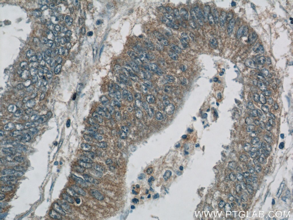 Immunohistochemistry (IHC) staining of human colon cancer tissue using NPR3 Polyclonal antibody (25248-1-AP)