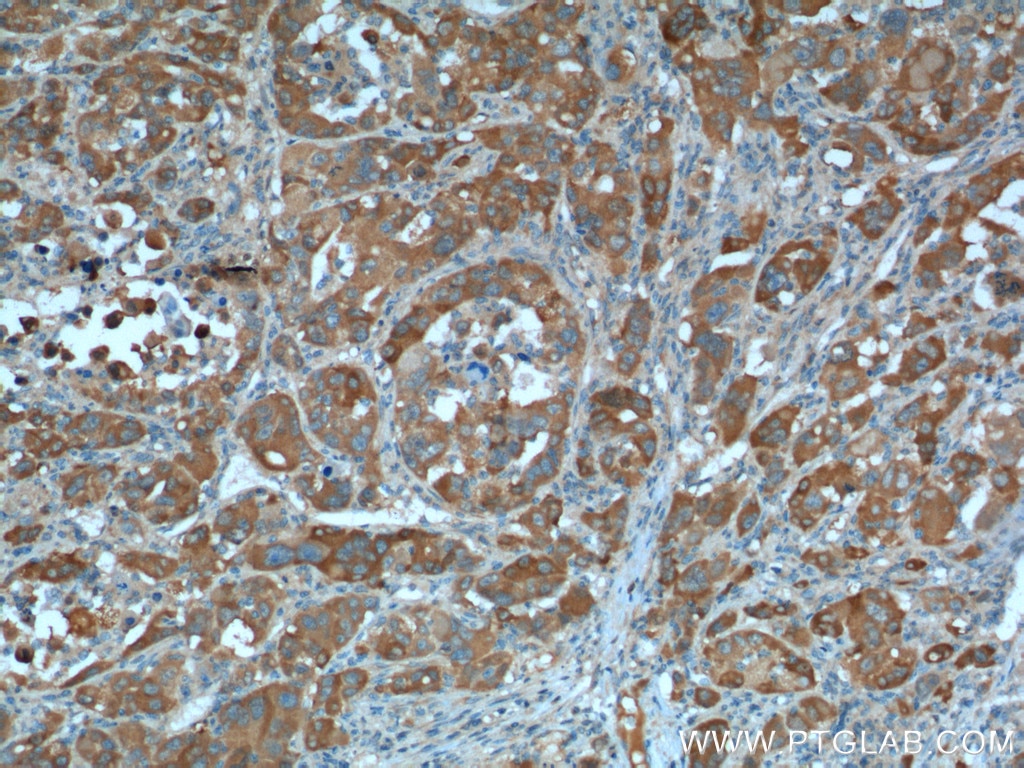 IHC staining of human liver cancer using 26706-1-AP