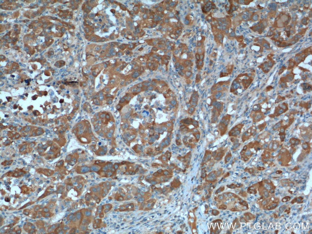 Immunohistochemistry (IHC) staining of human liver cancer tissue using NPR3 Polyclonal antibody (26706-1-AP)