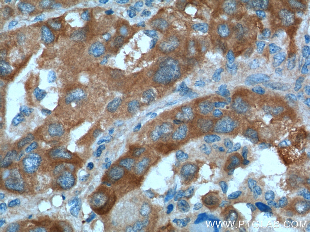 Immunohistochemistry (IHC) staining of human liver cancer tissue using NPR3 Polyclonal antibody (26706-1-AP)