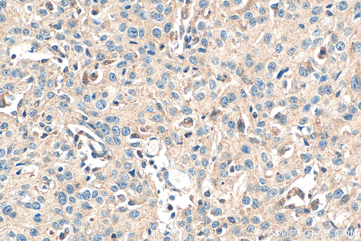 Immunohistochemistry (IHC) staining of human cervical cancer tissue using NPRL3 Polyclonal antibody (26446-1-AP)