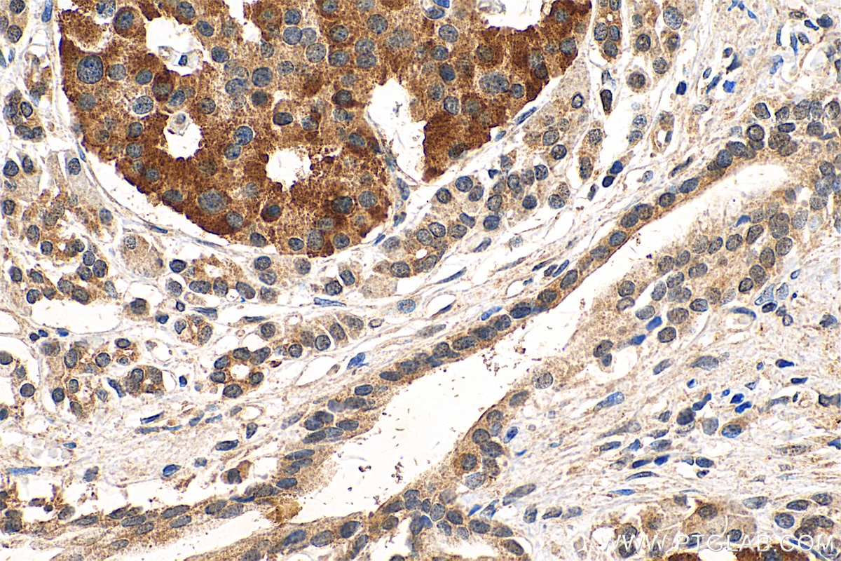 Immunohistochemistry (IHC) staining of human pancreas cancer tissue using NPS Polyclonal antibody (23609-1-AP)