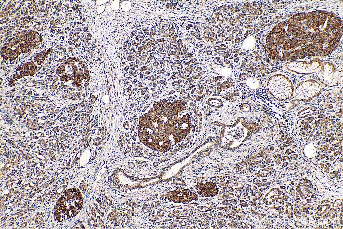 Immunohistochemistry (IHC) staining of human pancreas cancer tissue using NPS Polyclonal antibody (23609-1-AP)