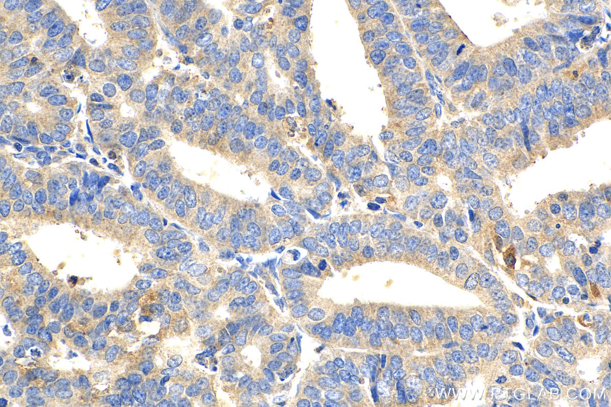 Immunohistochemistry (IHC) staining of human endometrial cancer tissue using NPSR1 Polyclonal antibody (25085-1-AP)