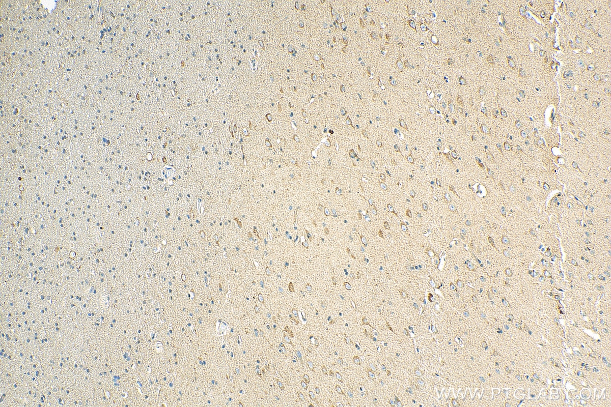 Immunohistochemistry (IHC) staining of human gliomas tissue using NPTX1 Polyclonal antibody (20656-1-AP)