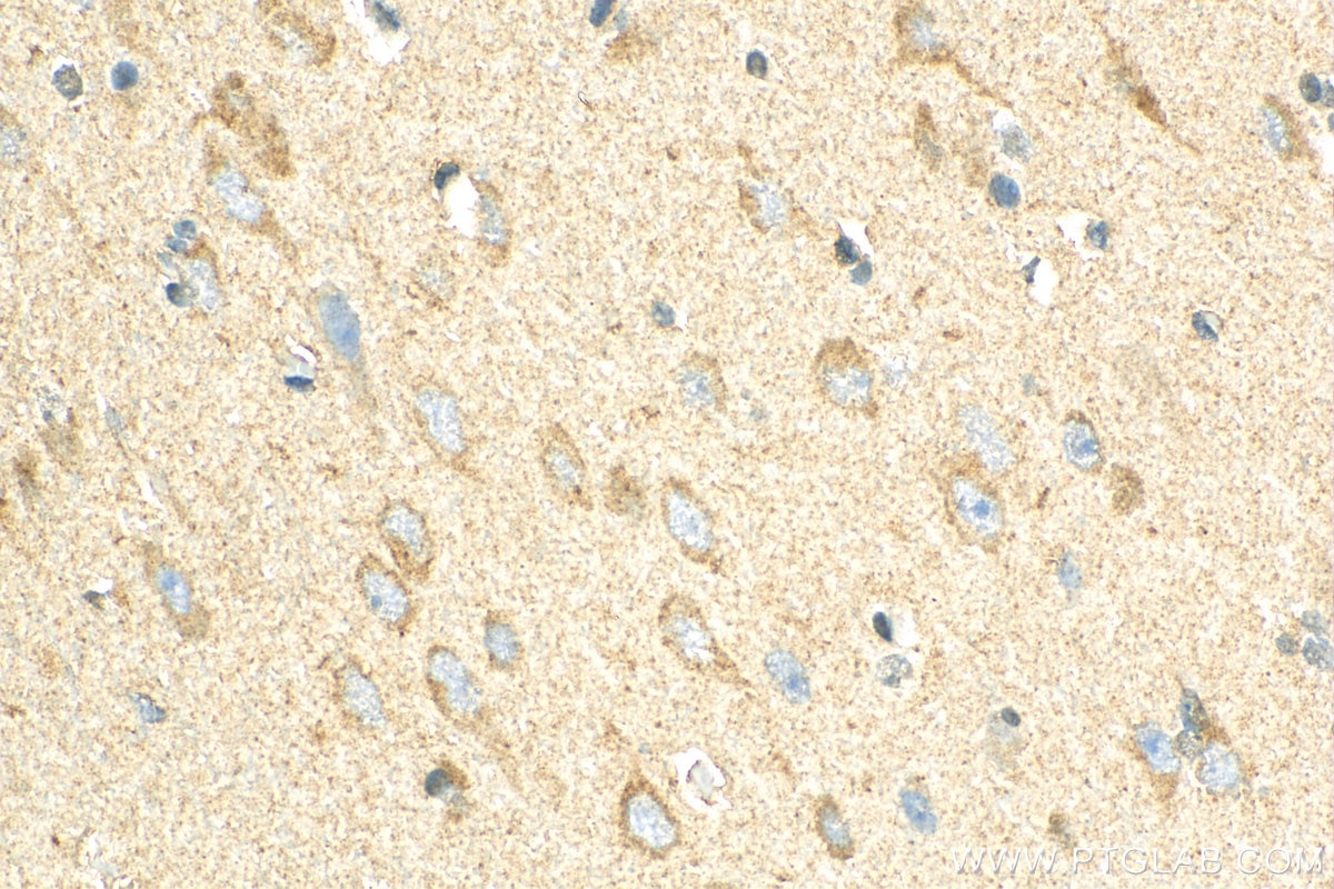 Immunohistochemistry (IHC) staining of human gliomas tissue using NPTX1 Polyclonal antibody (20656-1-AP)