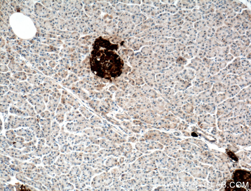 IHC staining of human pancreas cancer using 10889-1-AP
