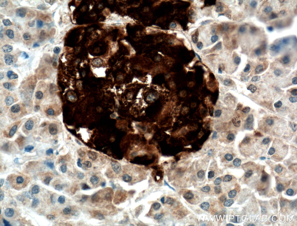 IHC staining of human pancreas cancer using 10889-1-AP