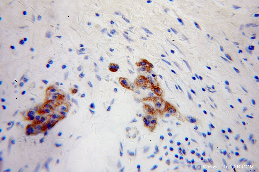 Immunohistochemistry (IHC) staining of human pancreas cancer tissue using NPTX2 Polyclonal antibody (10889-1-AP)